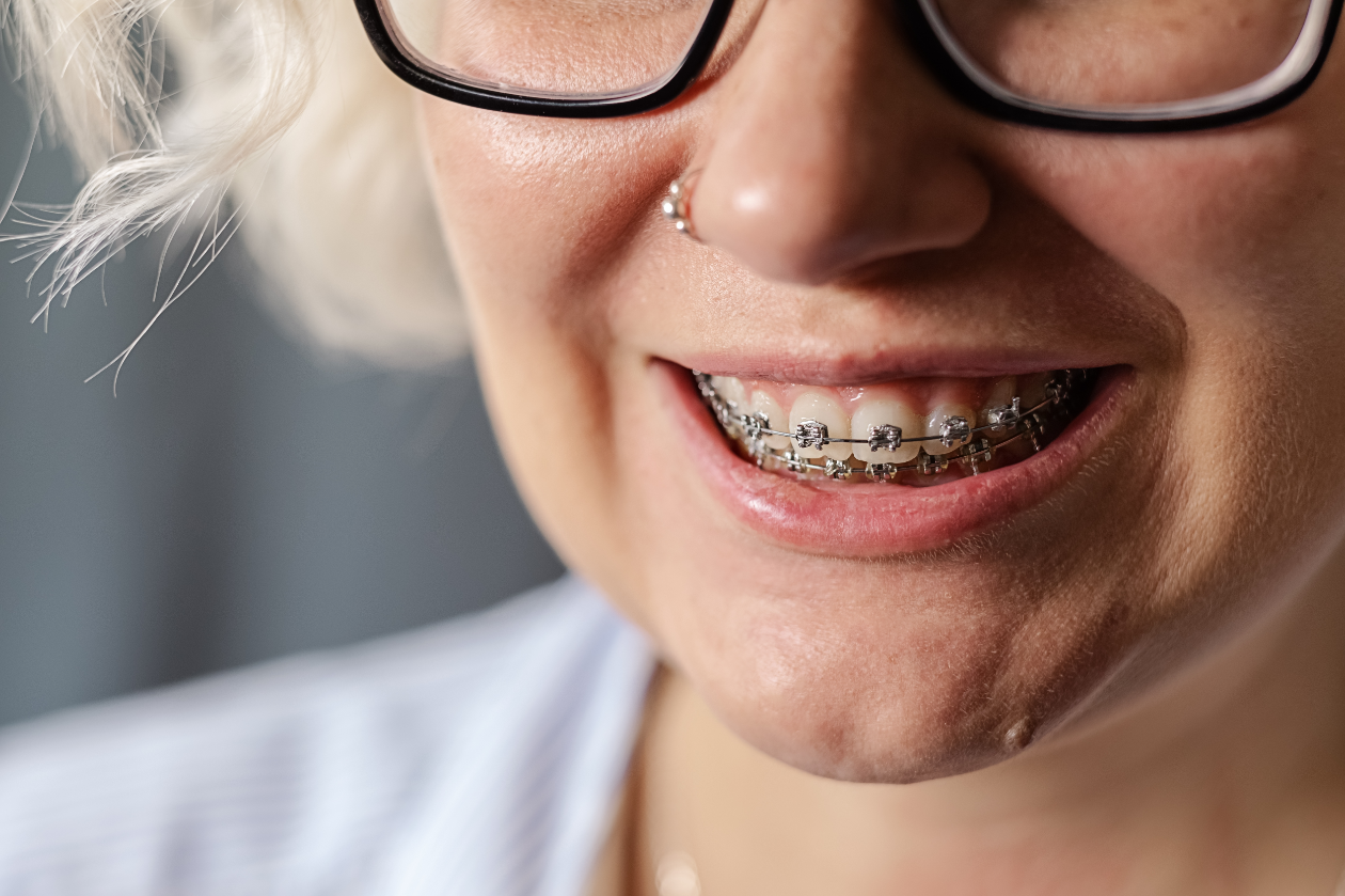 Is It Too Late for Braces? Orthodontic Treatment for Adults